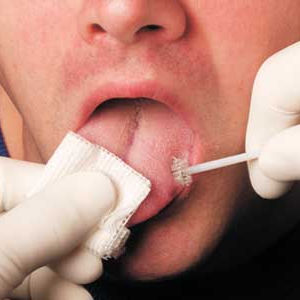 Mund-Zytologiebürste - OralCDx® - CDx Diagnostics - zum Einmalgebrauch