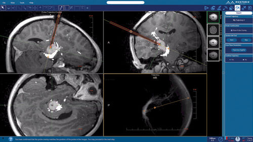 Planungssoftware - NeuroBlate ® SoftwareTM NeuroBlate ® - Monteris Medical - Beschaffung / Konturierung / für medizinische Bildgebung