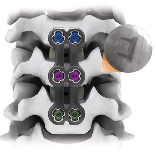 Arthrodeseplatte für Halswirbel - IRIS® - Life Spine - mit Verriegelung / 2 Ebenen