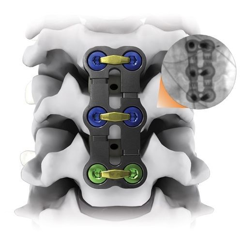 HWS-Arthrodeseplatte - KINETIC® - Life Spine - mit Verriegelung / Metall / 2 Ebenen
