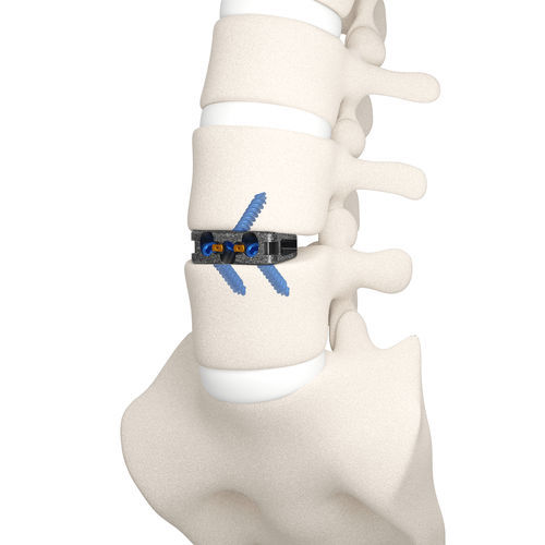 LWS-Zwischenwirbelimplantat - DYNA-LINK® - Life Spine - ventraler Zugang / Titan