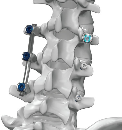 Thorako-lumbales Stabilisierungssystem für Osteosynthese - ARx® - Life Spine - dorsaler Zugang / für Erwachsene