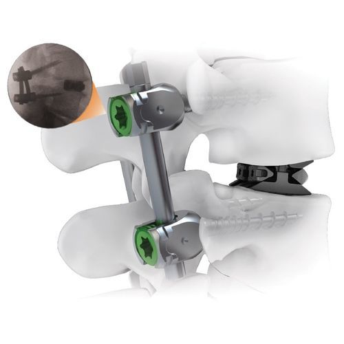 Thorako-lumbales Stabilisierungssystem für Osteosynthese - CENTERLINE® - Life Spine - dorsaler Zugang / für Erwachsene