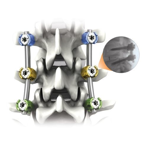 Thorako-lumbales Stabilisierungssystem für Osteosynthese - NAUTILUS® - Life Spine - dorsaler Zugang / für Erwachsene