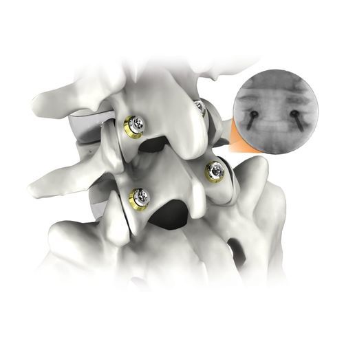 Thorako-lumbales Stabilisierungssystem für Osteosynthese - FS3® - Life Spine - dorsaler Zugang / für Erwachsene