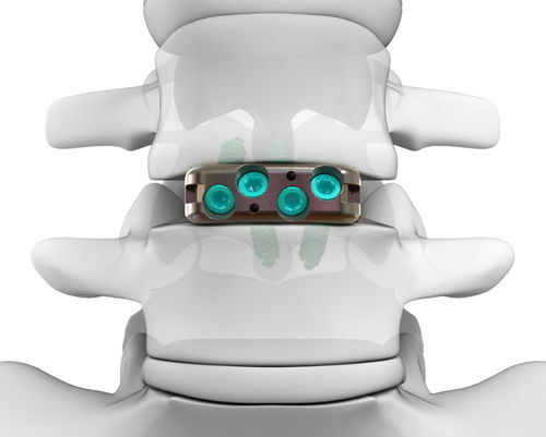 LWS-Zwischenwirbelimplantat - DYNA-LINK® ELITE - Life Spine - ventraler Zugang