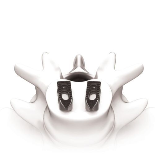 Thorako-lumbales Zwischenwirbelimplantat - PLATEAU®-Ti - Life Spine - ventraler Zugang / Titan