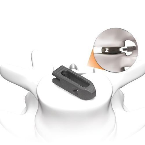 Thorako-lumbales Zwischenwirbelimplantat - PLATEAU®-Z - Life Spine - dorsaler Zugang / transforaminaler Zugang / Titan