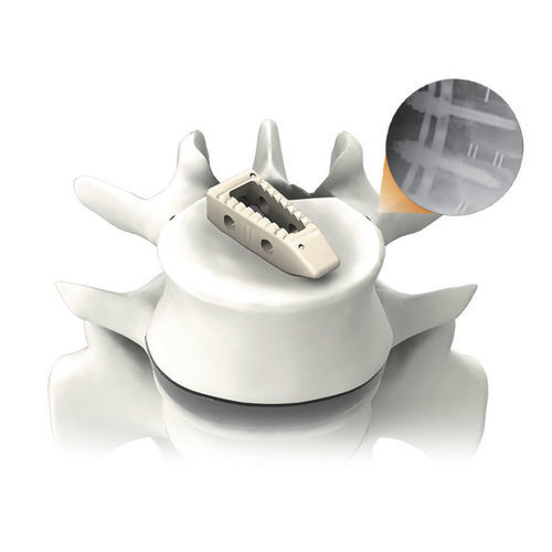 Thorako-lumbales Zwischenwirbelimplantat - PLATEAU®-P - Life Spine - dorsaler Zugang / aus PEEK