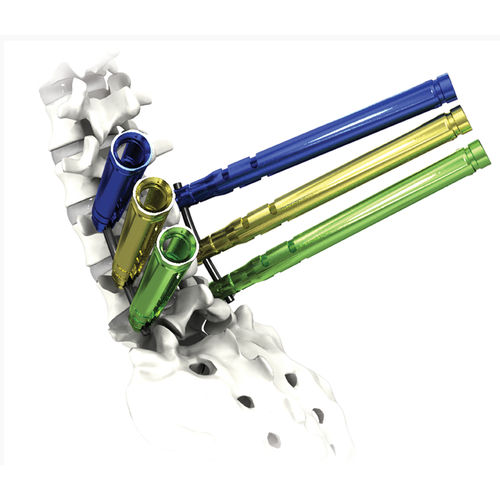 Thorako-lumbales Stabilisierungssystem für Osteosynthese - AVATAR® - Life Spine - dorsaler Zugang / für Erwachsene