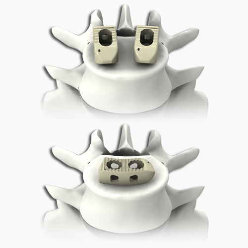 LWS-Zwischenwirbelimplantat - PLATEAU® - Life Spine - dorsaler Zugang / transforaminaler Zugang / aus PEEK