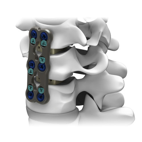 HWS-Arthrodeseplatte - GRUVE™ - Life Spine - mit Verriegelung / Metall / 2 Ebenen