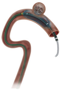 Okklusionskatheter - Scepter C® - MicroVention - Blutgefäß / Ballon / mit hydrophiler Beschichtung