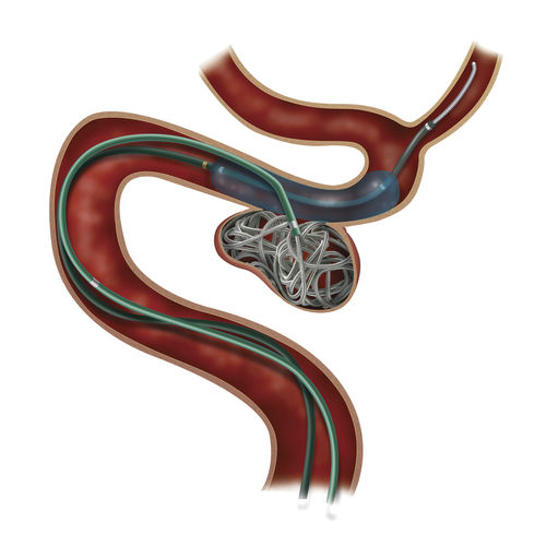 Transseptaler Zugangsschaft - Headway® Duo - MicroVention