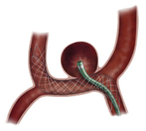 Peripherer Stent - LVIS™ Jr. - MicroVention - Nitinol / selbstexpandierend