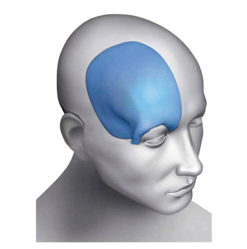 Patientenspezifisches Schädelimplantat - Matrix Omnipore®  - Acumed