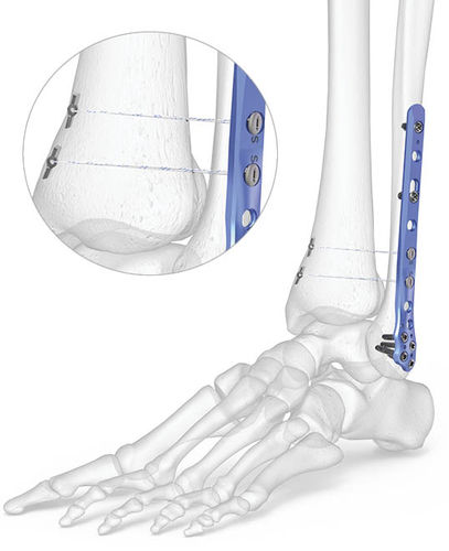 Kompressionsplatte für Tibia - 7007-0 series - Acumed - für Fibula / für Knöchel / distal