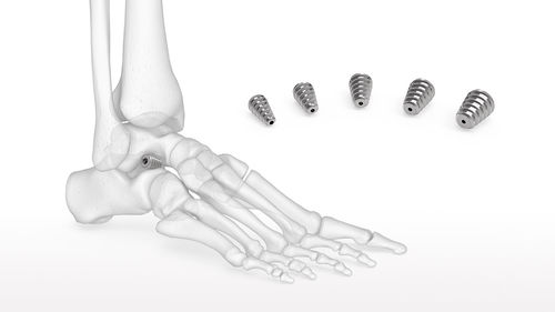 Subtalargelenk-Implantat - Talar-Fit™ - Acumed