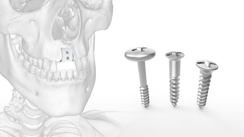 Knochenimplantologie-Instrumentenset -  Mincro™ - Acumed