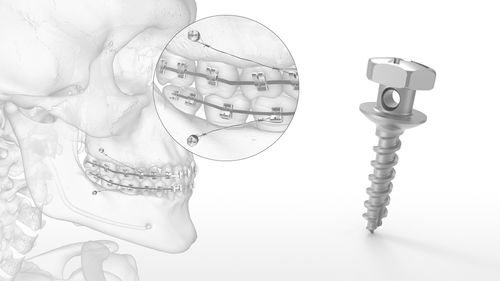Mini-Implantat / Titan - OMI™ - Acumed - Schrauben / zur kieferorthopädischen Verankerung / kortikal