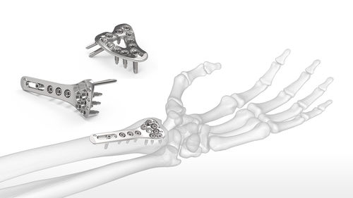 Kompressionsplatte für Radius -  ExtremiLock™ - Acumed - für Handgelenk / distal / mit Verriegelung