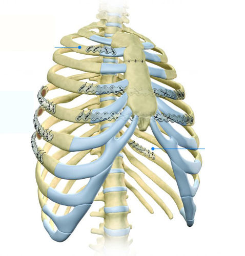Kompressionsplatte für Rippen - BioBridge - Acumed - proximal / medial / Metall