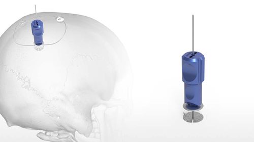 Nicht resorbierbares Schädelfixierungssystem - OsteoFlap™ - Acumed