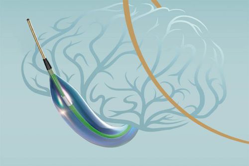 Dilatationskatheter - Neuro LPS™ - SINOMED - Neurologie / Ballon