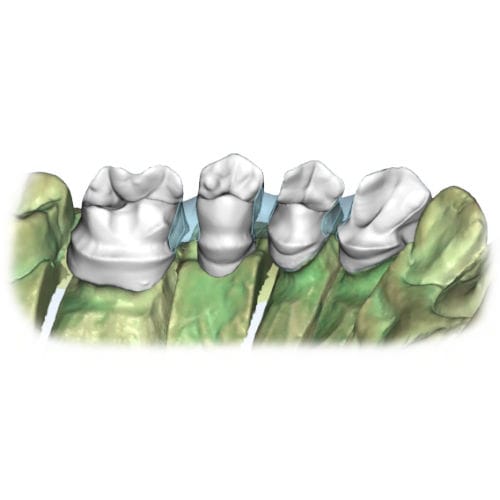 Dental-Software - Restoration - AGE Solutions - Labor / Ausbildung / CAD