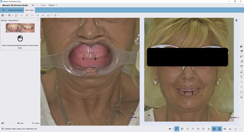 Software-Modul / Dental - 3D Denture Guide - AGE Solutions - Erfassung
