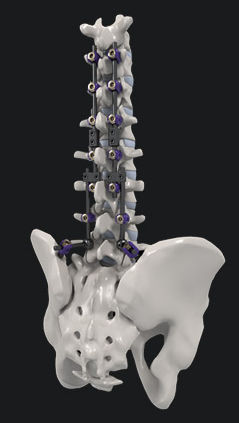 Thorako-lumbales Stabilisierungssystem für Osteosynthese - SYNSTER® DOMINO - BM Korea - dorsaler Zugang / für Erwachsene