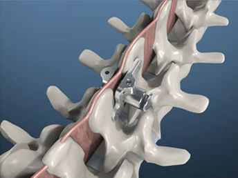Interspinales Wirbelkörperimplantat / LWS - PITBULL® - BM Korea - Kreuzbein / Thorax