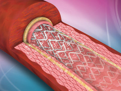 Koronararterien-Stent - ReNATURAL - Cardionovum - Metall / bioresorbierbar
