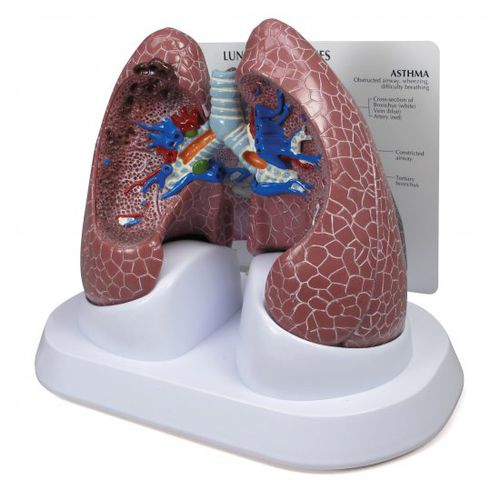 Anatomisches Lungenmodell - 3110 - GPI Anatomicals - für die Ausbildung / für Krebserkrankungen / für COPD