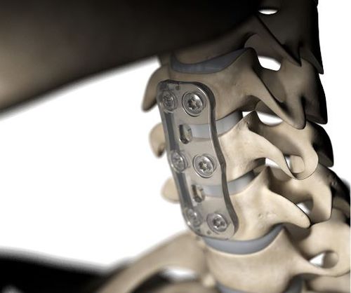 Arthrodeseplatte für Halswirbel - S-1™ - Inion - aus bioresorbierbarem Polymer / 2 Ebenen / 1 Ebene