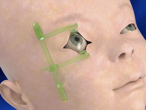 Augenlider-Spekulum - Neotech Products - für Kinder / Einweg