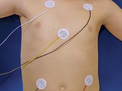 EKG-Elektrode / Pädiatrie - NeoLead® - Neotech Products - Monitoring / strahlendurchlässig