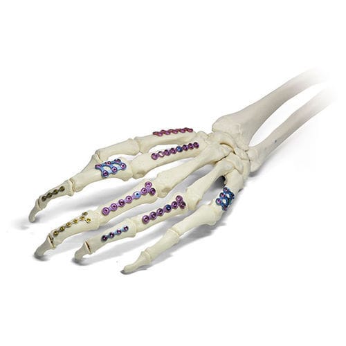 Kompressionsplatte für Fingerglied - SIGNEX - OSTEONIC - mit Verriegelung / Metall