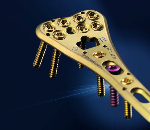 Kompressionsplatte für Radius - SIGNEX - OSTEONIC - distal / mit Verriegelung / Metall