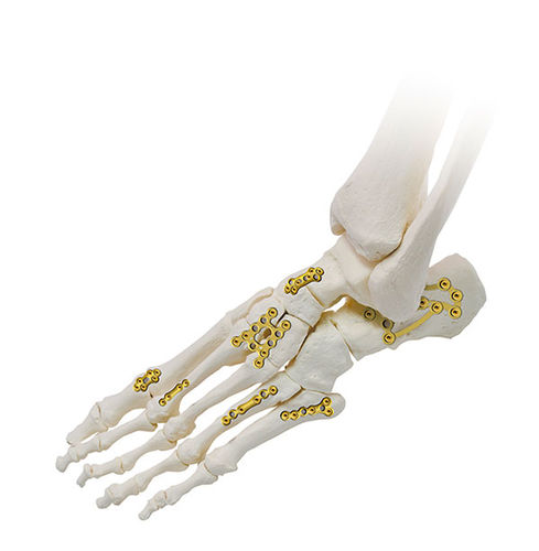 Kompressionsplatte für Fuß - SIGNEX - OSTEONIC - mit Verriegelung / Metall