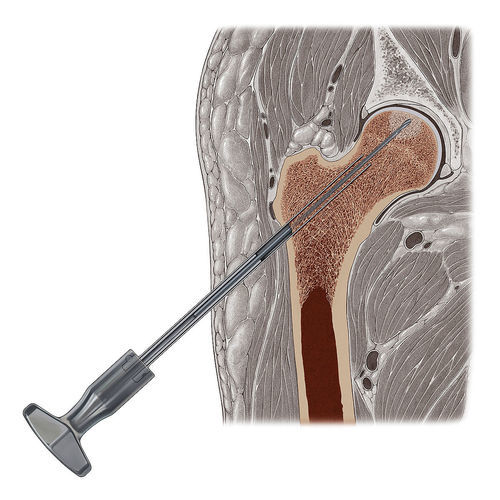 Schleimhautstanze für Hüftchirurgie - 710000 - Eberle - für Knochenprofiling / für Arthroskopie