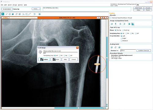 Software / Präoperative Planung - Hip Arthroplasty - OrthoView - für Hüftchirurgie / für orthopädische Chirurgie / medizinisch