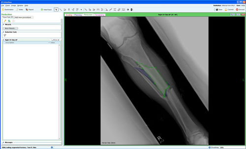 Software-Modul / Management - Fracture Management - OrthoView - Planung / für orthopädische Chirurgie