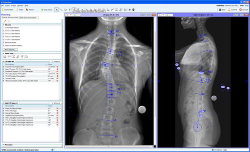 Software-Modul / Management - Spinal Deformity Assessment - OrthoView - Präoperative Planung / für orthopädische Chirurgie / Wirbelsäule