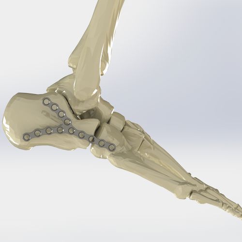 Kompressionsplatte für Calcaneum - 36.380.13 - Medicalex - ohne Verriegelung / Metall