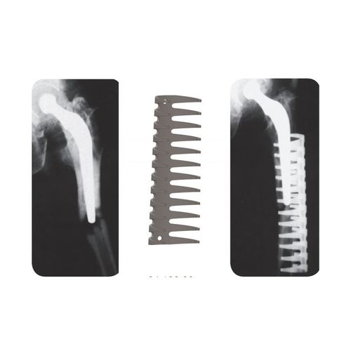 Kompressionsplatte für periprothetische Femur-Fraktur - 34.100.00 - Medicalex - ohne Verriegelung / Metall