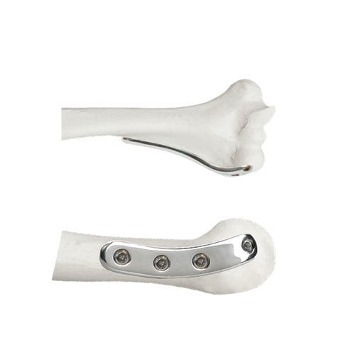Kompressionsplatte für Humerus - 37.801 series - Medicalex - distal / seitlich / mit Verriegelung