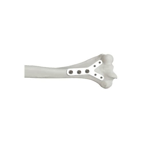 Kompressionsplatte für Epiphyse - 37.802.0 series - Medicalex - für Humerus / distal / mit Verriegelung