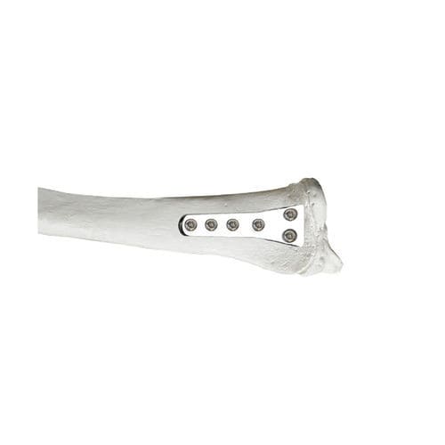 Kompressionsplatte für Radius - 37.800 series - Medicalex - distal / mit Verriegelung / Metall