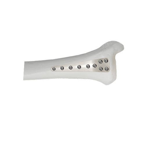 Kompressionsplatte für Tibia - 37.804 series - Medicalex - distal / anterolateral / mit Verriegelung